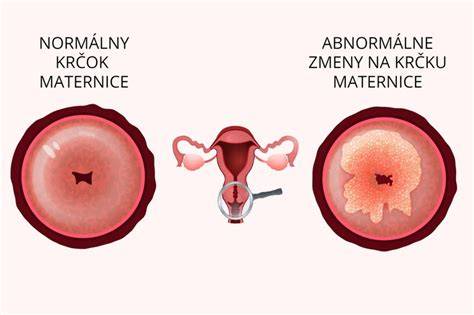 schéma krčka maternice a označenie vonkajšej a vnútornej bránky