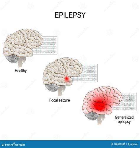 Diagram rozdelenia epilepsy na idiopatickú, symptomatickú a reaktívnu