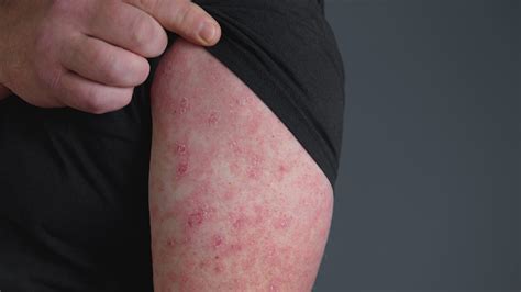 Ilustrácia psa s viditeľnými príznakmi kvasinkovej infekcie na koži a ušiach