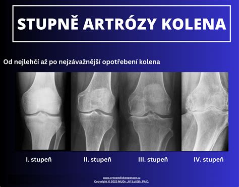 Porovnanie účinnosti fyzikálnej terapie a injekcií pri osteoartróze kolena