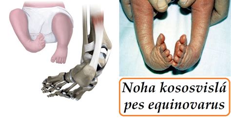 Schematické znázornenie deformácie nohy pri pes equinovarus