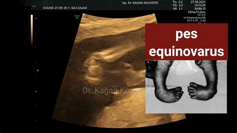 Ultrazvukové zobrazenie plodu s podozrením na pes equinovarus