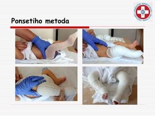 Ukážka Ponsetiho metódy sadrovania nožičky