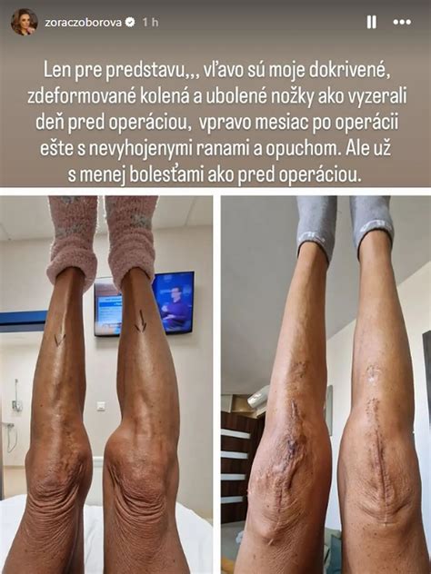 Žena sa teší z lepšej kvality života po operácii