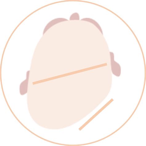 porovnanie tvarov hlavičky: plagiocefália, brachycefália, dolichocefália