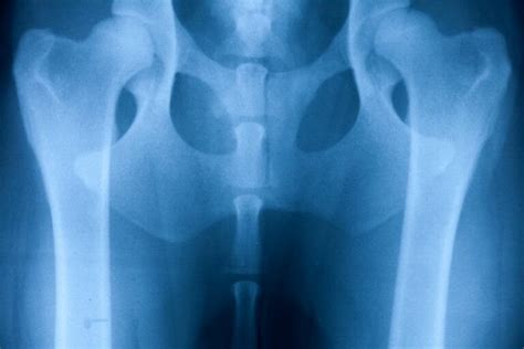 Rentgenový snímok bedrového kĺbu psa s dyspláziou