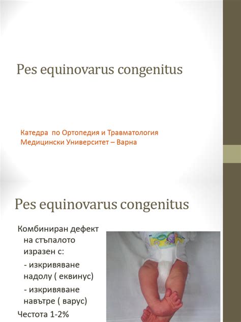 Infografika zobrazujúca jednotlivé kroky Ponsetiho metódy liečby pes equinovarus