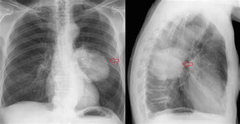 Porovnanie kapacity pľúc plavcov a bežcov
