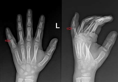 RTG snímka zlomeného prsta psa