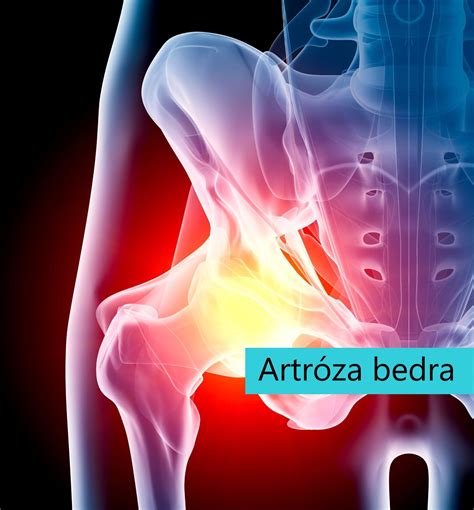 Ilustrácia kostí bedrového kĺbu s vyznačenou dyspláziou