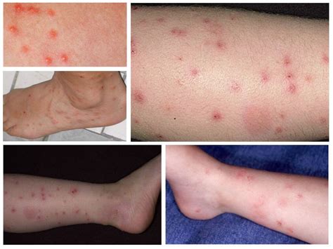 Ilustrácia blchy na ľudskej koži