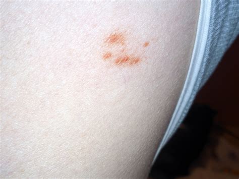 Pes s kruhovou lysinou na koži