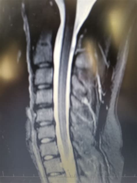 Ilustrácia MRI skenu chrbtice psa