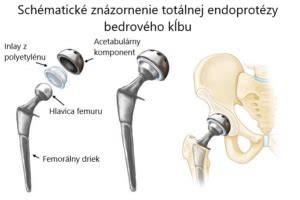 Obrázok: Schéma anatómie bedrového kĺbu a zona kritickej oblasti pre DBK