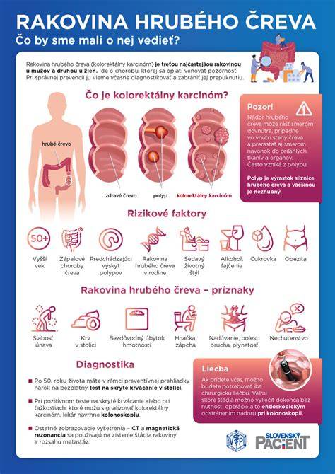 Infografika: Ako vznikajú hemoroidy a čreva v rovnováhe