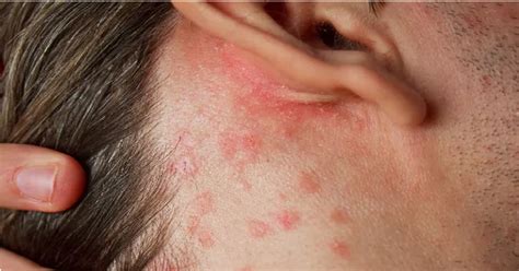 Pes s atopickou dermatitídou