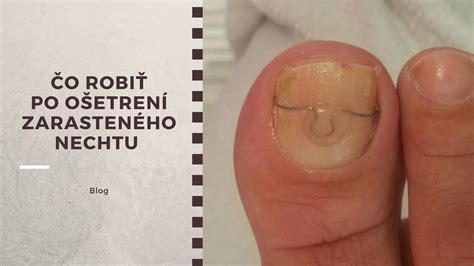 Schema znázorňujúca štádiá zarasteného nechtu