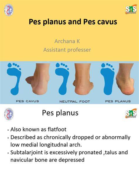 Infografika: Rozdiely medzi PES PLANUS a PES EQUINUS, ich príznaky a liečba