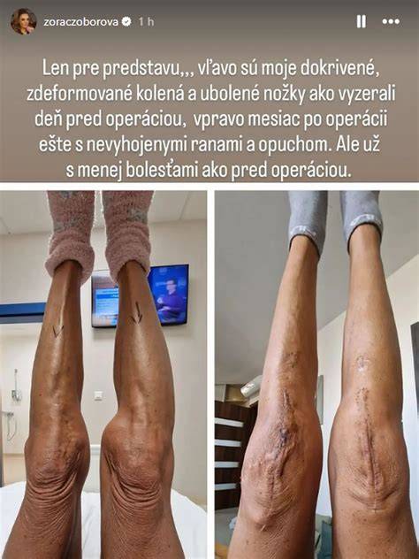 Infografika: Pooperančná starostlivosť po operácii prietrže - kroky a bezpečnostné opatrenia