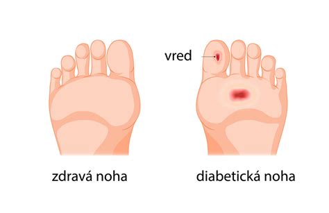 Infografika: Patofyziológia diabetickej nohy a diagnostické postupy