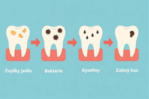 Infografika: Ako vzniká zubný plak a kameň, a ako ich predchádzať