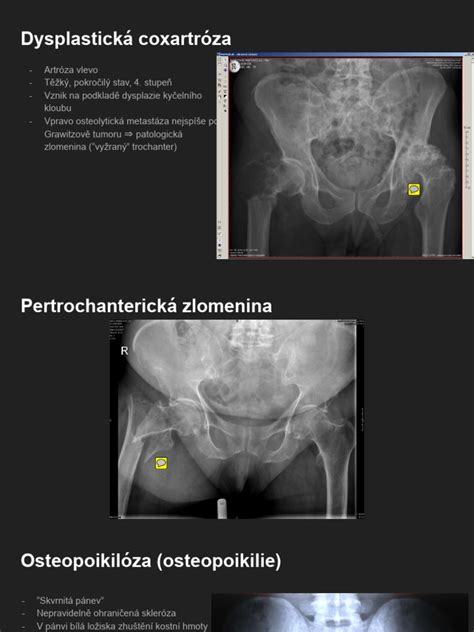 RTG snímky bedrového kĺbu s označením Norbergovho uhla
