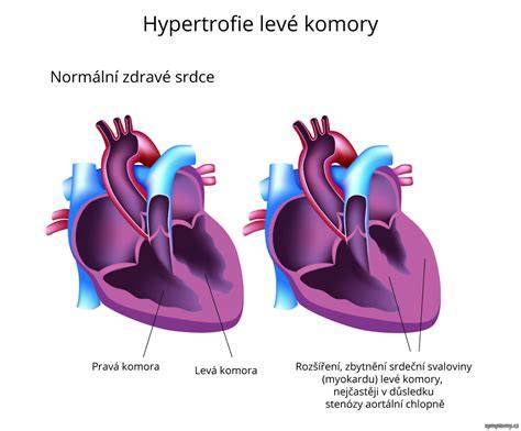 Infografika: Diagnostika a liečba hypertrofie ľavej komory u psov
