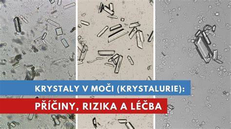 Štúdia kryštálov v moči: struvit a iné typy