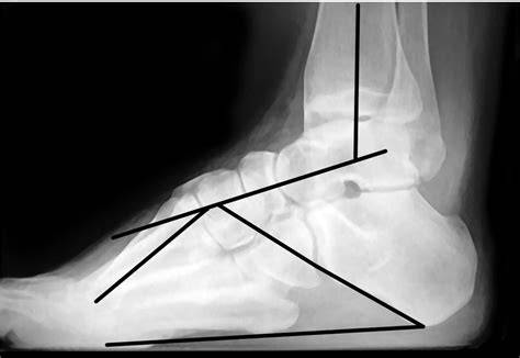 Infografika: anatomická schéma pes cavus, rozdelenie apexu deformity a možnosti korekčných zákrokov